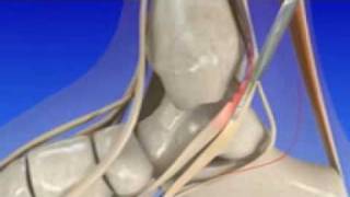 Introduction to Posterior Tibial Tendon Dysfunction [upl. by Damalas313]