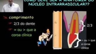 Aula de Núcleo intrarradicular [upl. by Oralla]