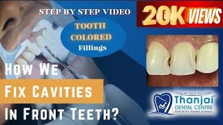 How to fix cavities between front teeth Composite filling video How dentist remove tooth decay [upl. by Eneles38]