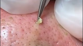 EXTRACTING plugged pores on the nose [upl. by Nosde815]