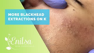 More Blackhead Extractions with K [upl. by Ahsaet424]