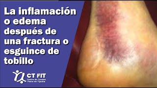 Inflamación de tobillo después de una fractura o esguince  Centro de Terapia Física de Tijuana [upl. by Mortie402]