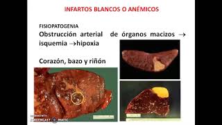 FISIOPATOLOGIA DEL INFARTO • Necrosis isquemica • Patologia médica [upl. by Arraet494]