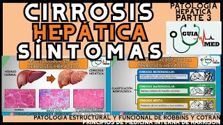 CIRROSIS HEPÁTICA SÍNTOMAS  GuiaMed [upl. by Bilski]