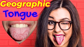 Benign Migratory Glossitis😛  Geographic👅 Tongue Homeopathic Treatment  Mapped Tongue 😜 [upl. by Hahseram]