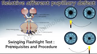 Pupil 3  How to Perform the Swinging Flashlight Test [upl. by Elvera]