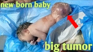 new baby with big tumorabnormal new born babynew baby born with a big tumor [upl. by Nuoras792]