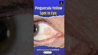 Pinguecula Yellow Spot in Eye Pinguecula eye testpaperlive [upl. by Yniatirb]