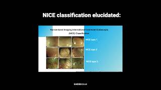 Endoscopic Identifications Key Tips for Differentiating Polyps [upl. by Llebiram]