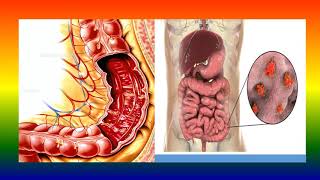 Bacillary Dysentery [upl. by Asiat]