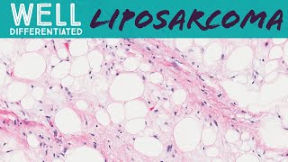 Well differentiated liposarcoma aka atypical lipomatous tumor pathology sarcoma soft tissue tumor [upl. by Schlosser551]