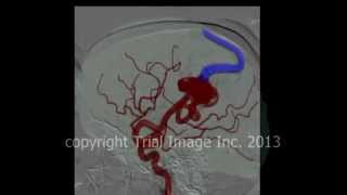 AVM  arteriovenous malformations in the brain amp cerebral hemorrhage animation by Cal Shipley MD [upl. by Genna]