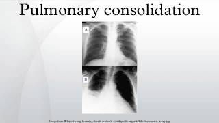 Pulmonary consolidation [upl. by Maurice]