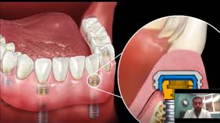 Dental Implant Overdenture  SnapIn Dentures [upl. by Dnalerb]