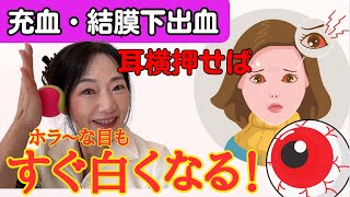 【充血・結膜下出血 】痛くも痒くもないけど目が真っ赤！充血を美しい白目に改善する！ [upl. by Aia]