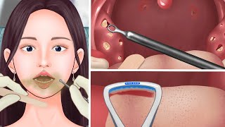 ASMR Cause of bad breath satisfying Tonsil Stone amp White Tongue removal animation  Bad Breath Care [upl. by Floridia]