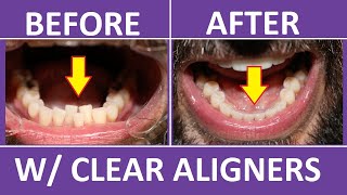 Invisalign Braces Before and After Overbite Crowding Teeth Cost Pain Tips 3M Clear Aligners [upl. by Lezah26]