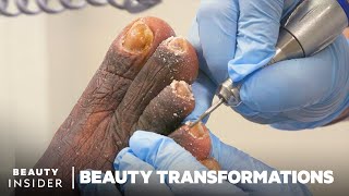 How Medical Pedicures Transform Feet [upl. by Amery]