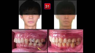 Ankylosis Case Analysis｜【Chris Chang Ortho】CC775 [upl. by Aliber72]