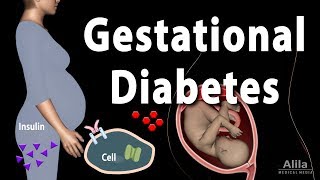 Gestational Diabetes Animation [upl. by Froehlich565]