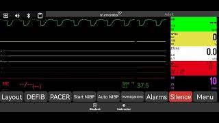 Pulseless Ventricular Tachycardia pVT [upl. by Sej]