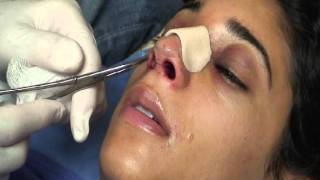 The Kotler Nasal Airway  Removal of the Airway [upl. by Avictor]