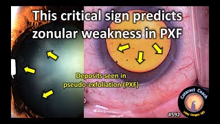 This critical sign predicts zonular weakness in PseudoExfoliation [upl. by Colly]