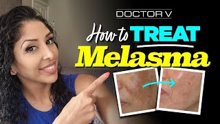 Doctor V  How To Treat Melasma  Skin Of Colour  Brown Or Black Skin [upl. by Fanchet263]