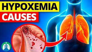 THIS is Causing Your Low Oxygen Levels  Hypoxemia Causes [upl. by Spiegleman]