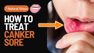 How to Treat Canker Sore  Gamot Sa Singaw Or Canker Sore  Home remedies for Canker Sore [upl. by Naltiak167]