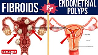 SIMILARITIES AND DIFFERENCES BETWEEN FIBROID AND ENDOMETRIAL POLYPSfibroid endometrium [upl. by Michigan]