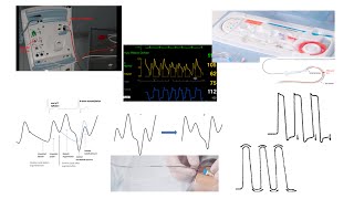 Balloon pump hemodynamics troubleshooting technical tips Elias Hanna [upl. by Arramat944]