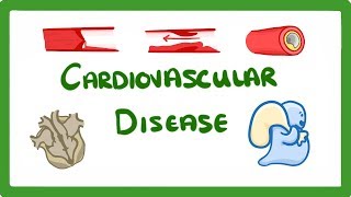 GCSE Biology  Why Do We Get Heart Disease and How to Treat It  Cardiovascular Disease CVD 47 [upl. by Cinda]