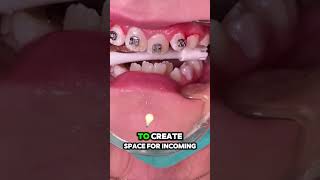 What is Phase 1 in orthodontic treatment  Tooth Time Family Dentistry New Braunfels [upl. by Janel453]