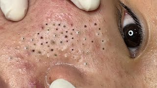 Treatment Blackheads and Acne Hidden Under The Eyes [upl. by Auqenahs219]