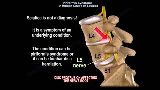 Piriformis Syndrome and Sciatica [upl. by Ahtebbat560]