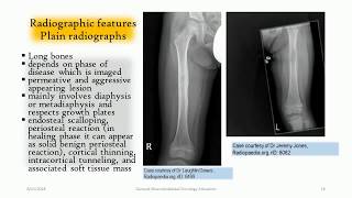 LangerhansCell Histiocytosis of the bone  ‘‘The great mimmicker’’ [upl. by Ahcmis654]