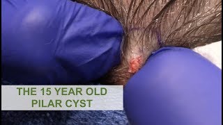 The 15 Year Old Cyst  Dr Derm [upl. by Mauer]