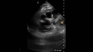 Severe Hydronephrosis  Ultrasound Image Interpretation [upl. by Orlina503]