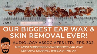 OUR BIGGEST EAR WAX amp SKIN REMOVAL EVER 2020  EP 302 [upl. by Cresida]