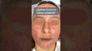 Los 4 mejores tratamientos de la rosácea rosacea rosaceaskincare [upl. by Beck759]