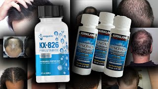 New Pyrilutamide KX826  Minoxidil Clinical Trial Will KX826 work [upl. by Idnarb46]