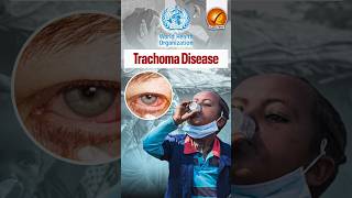 Trachoma Disease shorts [upl. by Gowon]