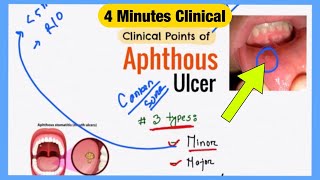 Aphthous Ulcer Explained Like Water  Symptoms Pathophysiology Treatment  Bengali Medicine Lecture [upl. by Andrien]