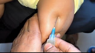 Arms injection video Intramuscular Ceftriaxone 500mg Exephin injection push24 P28 by cannula 69 [upl. by Ettevey]