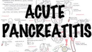 Acute Pancreatitis  Overview signs and symptoms pathophysiology investigations treatment [upl. by Gnud479]