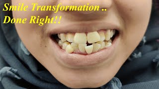 Severe Crowding Braces Treatment Before amp After Orthodontic Rx Smile Transformation  Dr Ram MDS [upl. by Pressman]