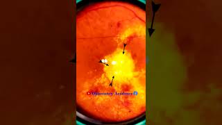 Diabetic retinopathy  Hemorrhages  Hard exudates  Fundus  Short Video 191 [upl. by Ruford]