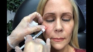 Dermal Filler Under Eyes Tear Trough Restylane and Radiesse [upl. by Nallek]