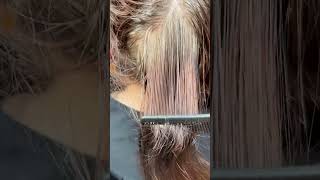 Scalp treatment for severe scalp psoriasis scalptreatment scalppsoriasis scalp [upl. by Sheeb82]